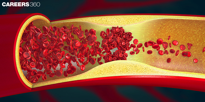 Does Cholesterol Damage Blood Vessels?