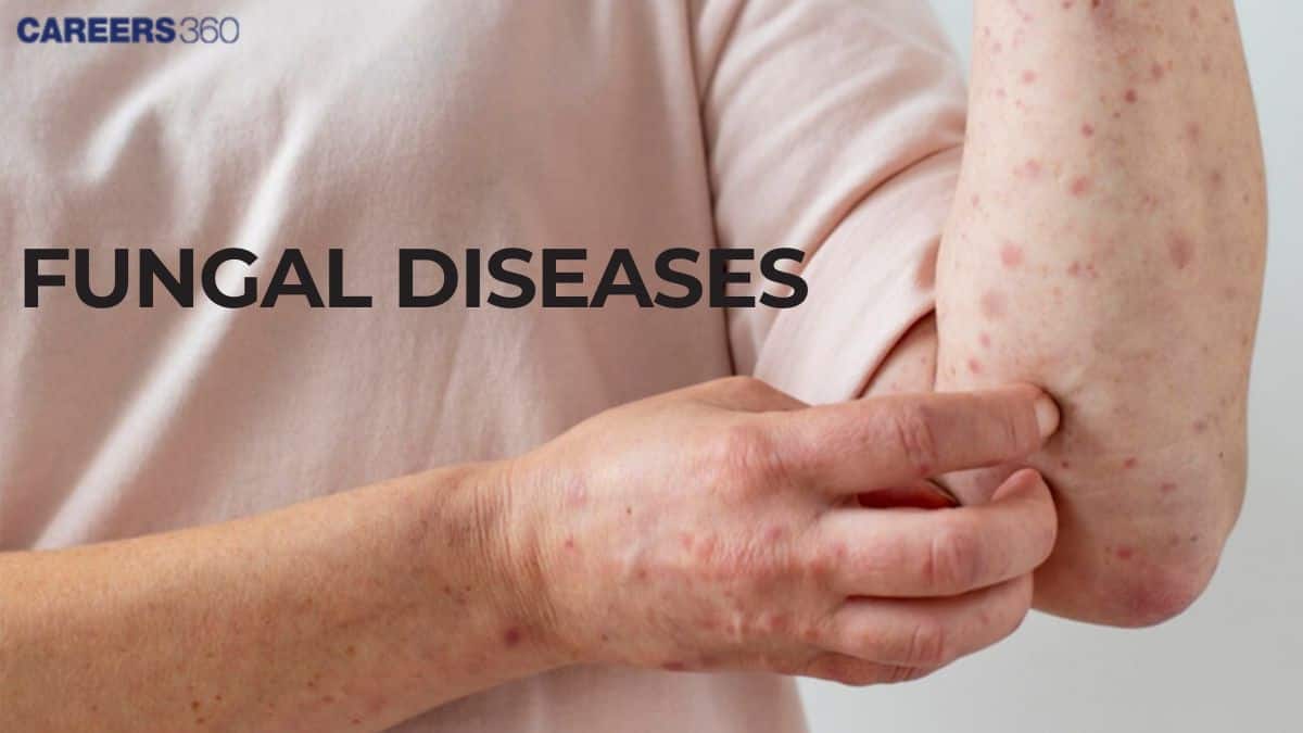 Fungal Infections: Meaning, Types, Examples, Treatment, Symptoms