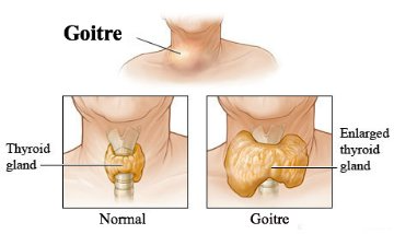 Thyroid