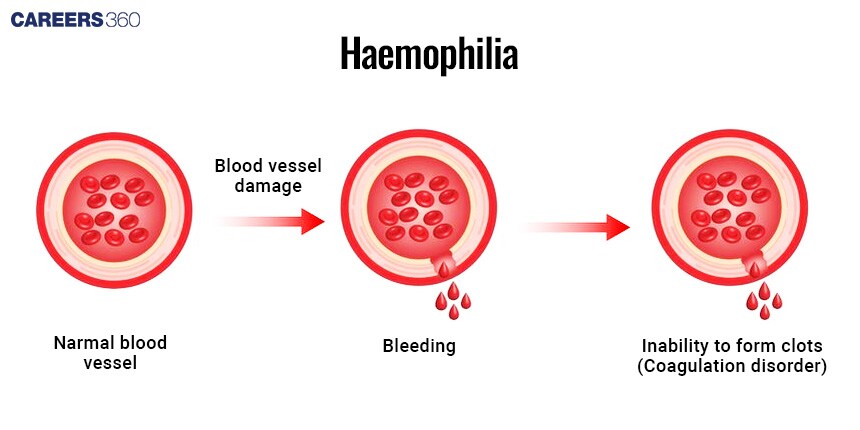 Hemophilia: Overview, Meaning, Causes, types, symptoms, treatment