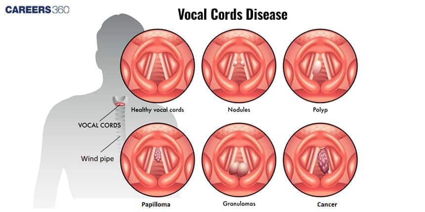 A medical illustration showing healthy vocal cords and common disorders like nodules, polyps, papilloma, granulomas, and cancer, each displayed in separate circular views.