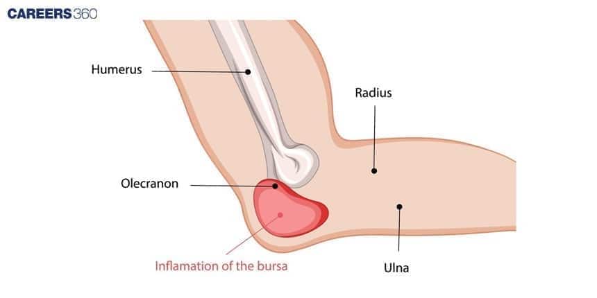 Diagram of the elbow joint showing humerus, radius, ulna, and inflammation of the olecranon bursa.