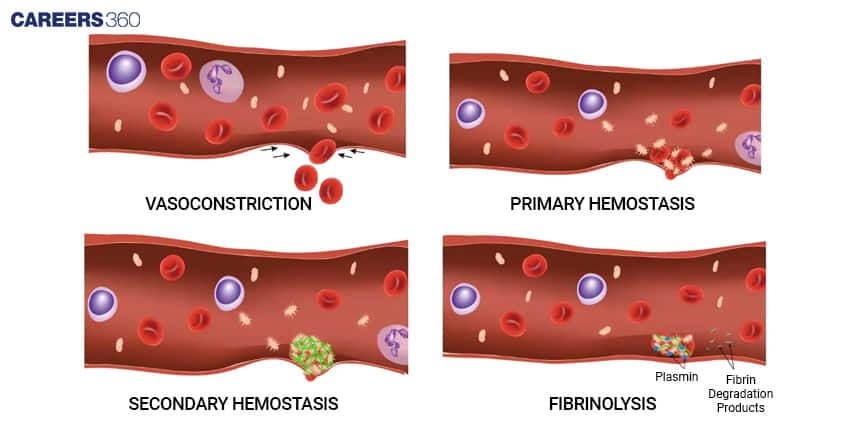 Diagram of four stages of hemostasis in a blood vessel: vasoconstriction to reduce blood flow, primary hemostasis with platelet plug formation, secondary hemostasis with fibrin clot formation, and fibrinolysis where plasmin breaks down fibrin into degradation products.